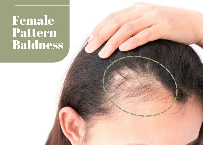 All You Need To Know About Female Pattern Baldness - Alchemane Hair Extensions