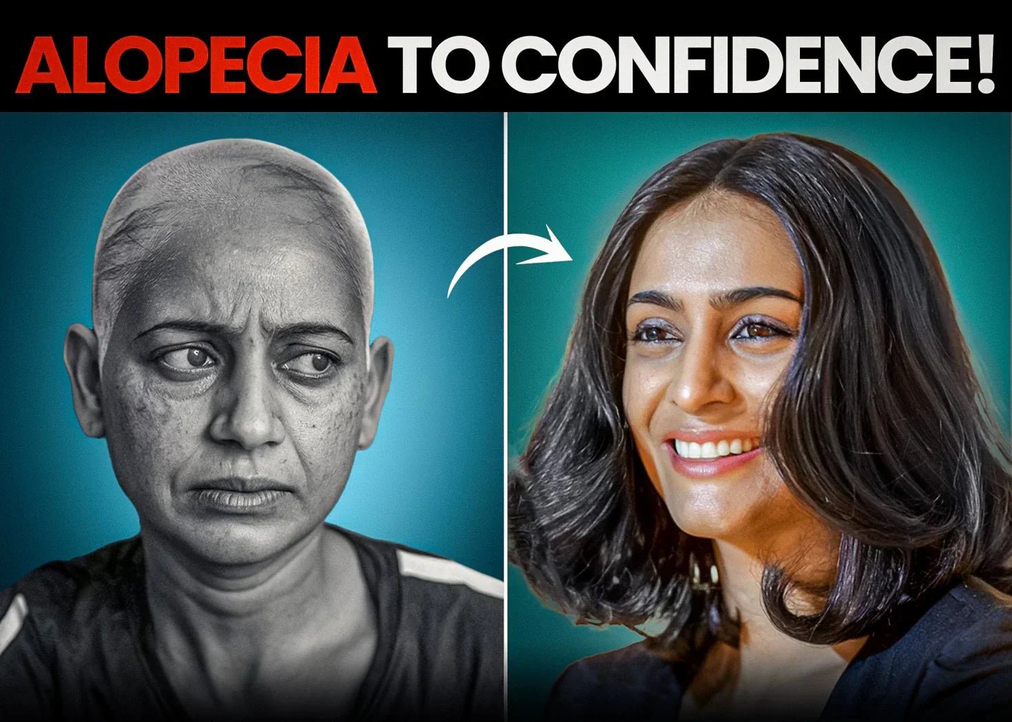 How Wigs Help Women with Alopecia Rediscover Their Beauty - Alchemane Hair Extensions