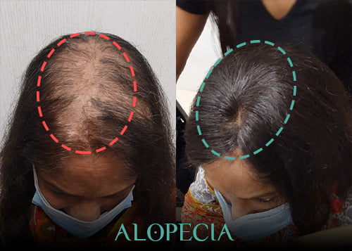 "Before-and-after results of a woman with alopecia. The left side displays significant hair thinning on the crown, while the right side shows a fuller and more natural-looking hair restoration. The transformation highlights the effectiveness of non-surgical hair replacement solutions."
