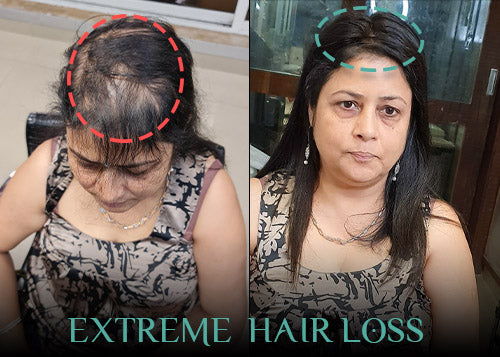 "Before-and-after transformation of a woman with extreme hair loss. The left side shows severe thinning on the crown, while the right side showcases a fuller, natural-looking hair restoration solution. The image highlights the effectiveness of non-surgical hair replacement."